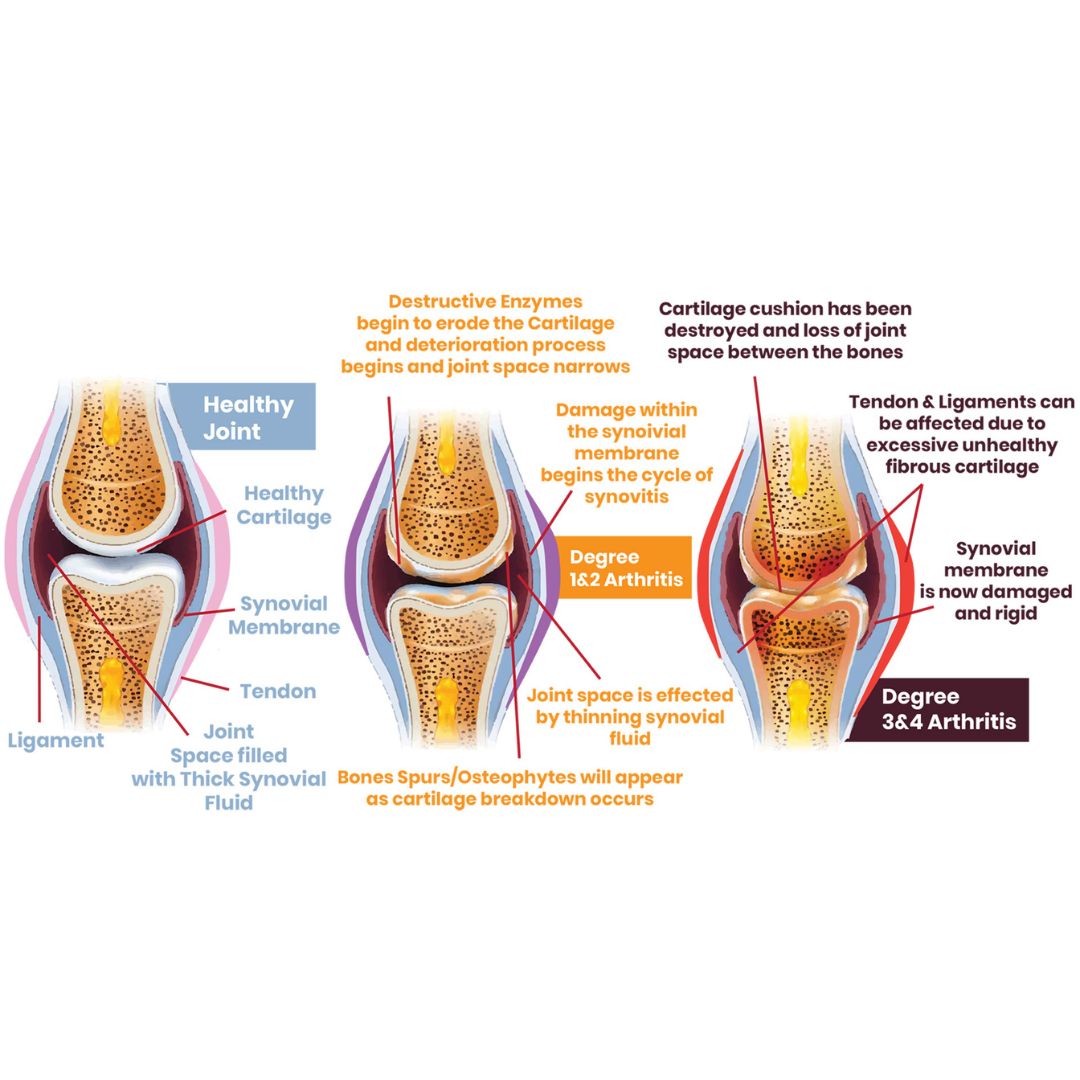Arthritis in horse through progression from healthy joint to early and advanced stages, showing changes.