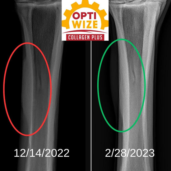 Fractured Splint Bone